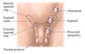criptorchidismo-2