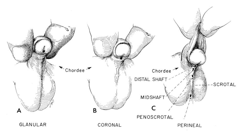 Ipospadia - Wikipedia